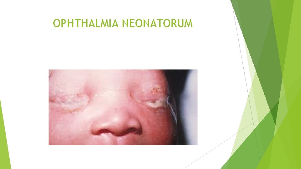 OPHTHALMIA NEONATORUM 