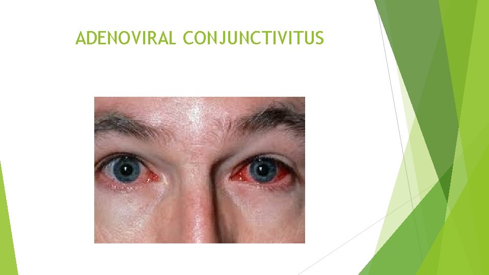 ADENOVIRAL CONJUNCTIVITUS 