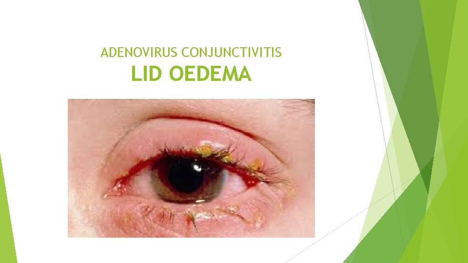 ADENOVIRUS CONJUNCTIVITIS LID OEDEMA 