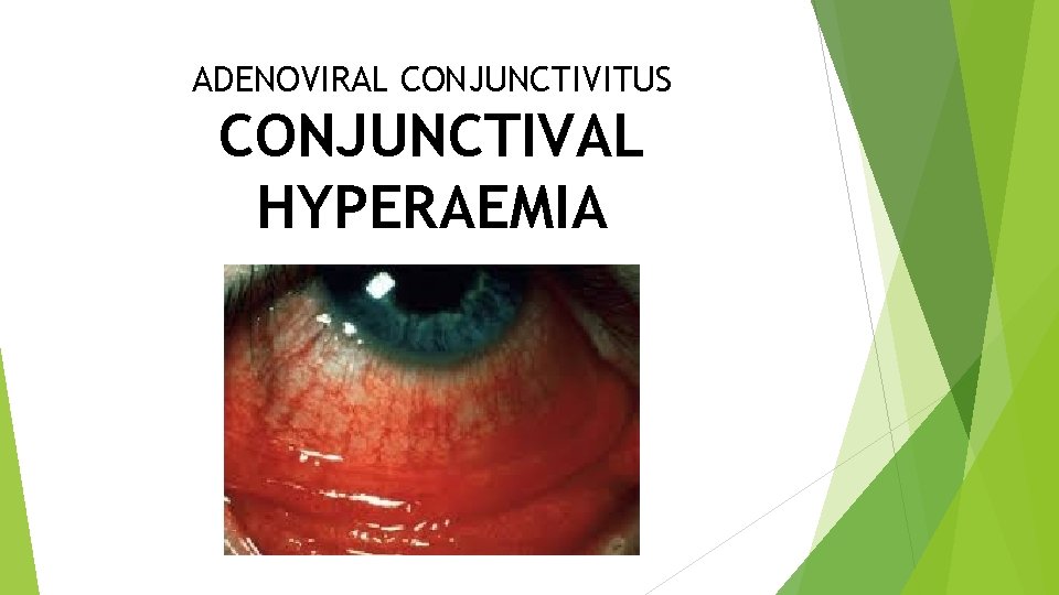 ADENOVIRAL CONJUNCTIVITUS CONJUNCTIVAL HYPERAEMIA 