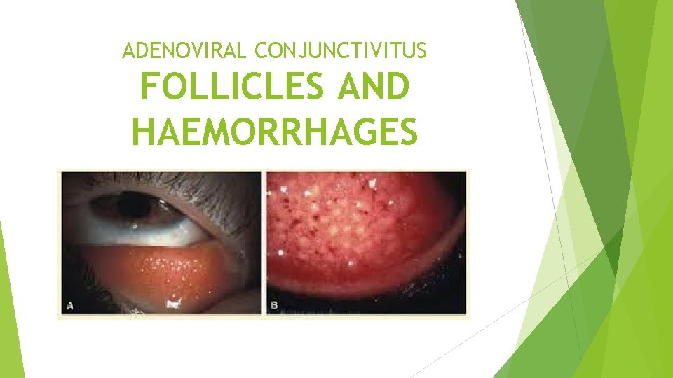 ADENOVIRAL CONJUNCTIVITUS FOLLICLES AND HAEMORRHAGES 