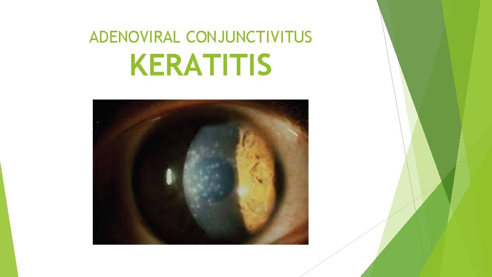 ADENOVIRAL CONJUNCTIVITUS KERATITIS 