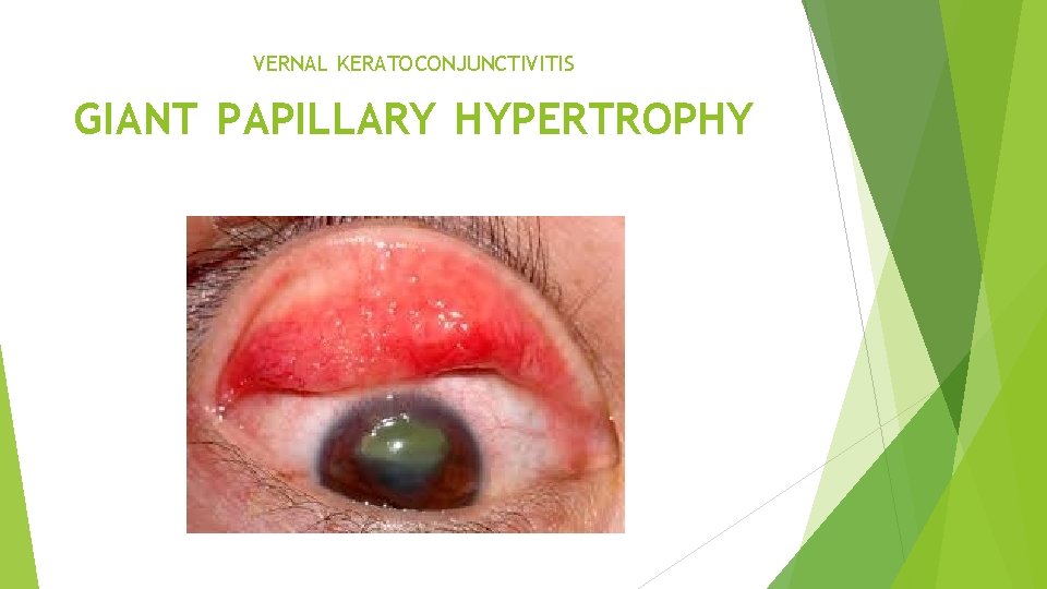 VERNAL KERATOCONJUNCTIVITIS GIANT PAPILLARY HYPERTROPHY 