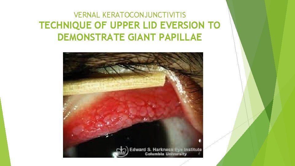 VERNAL KERATOCONJUNCTIVITIS TECHNIQUE OF UPPER LID EVERSION TO DEMONSTRATE GIANT PAPILLAE 