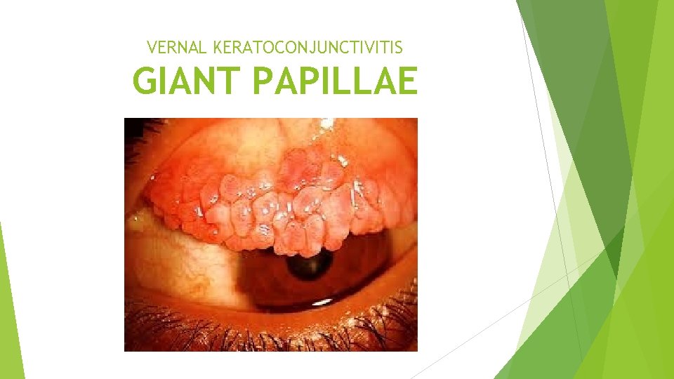 VERNAL KERATOCONJUNCTIVITIS GIANT PAPILLAE 