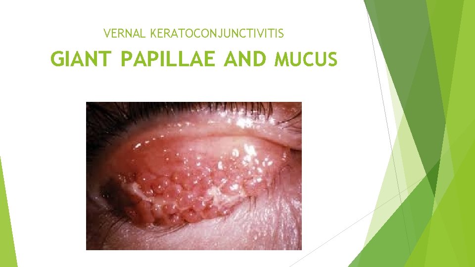 VERNAL KERATOCONJUNCTIVITIS GIANT PAPILLAE AND MUCUS 