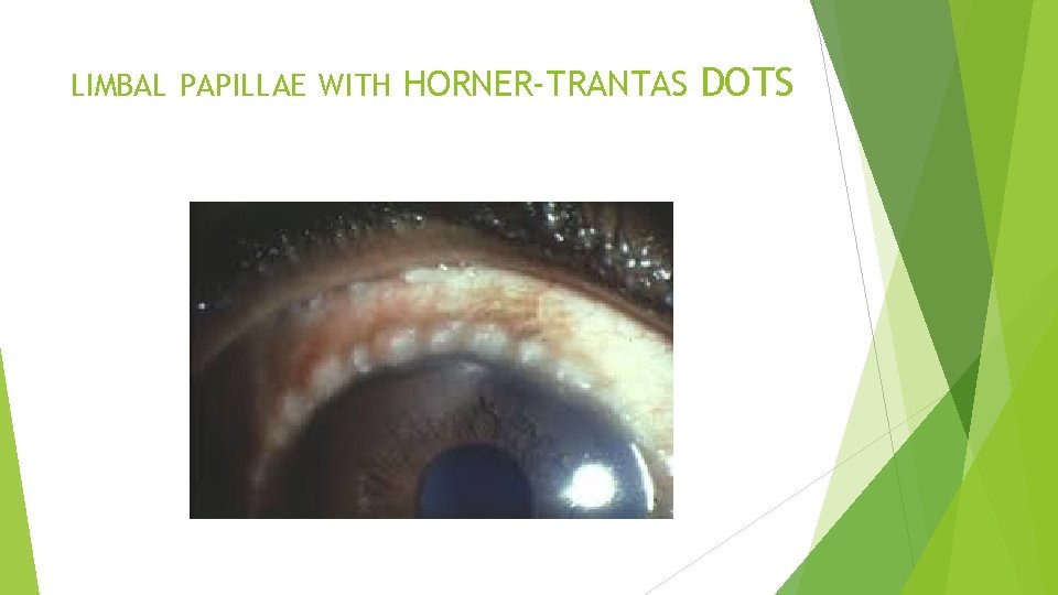LIMBAL PAPILLAE WITH HORNER-TRANTAS DOTS 