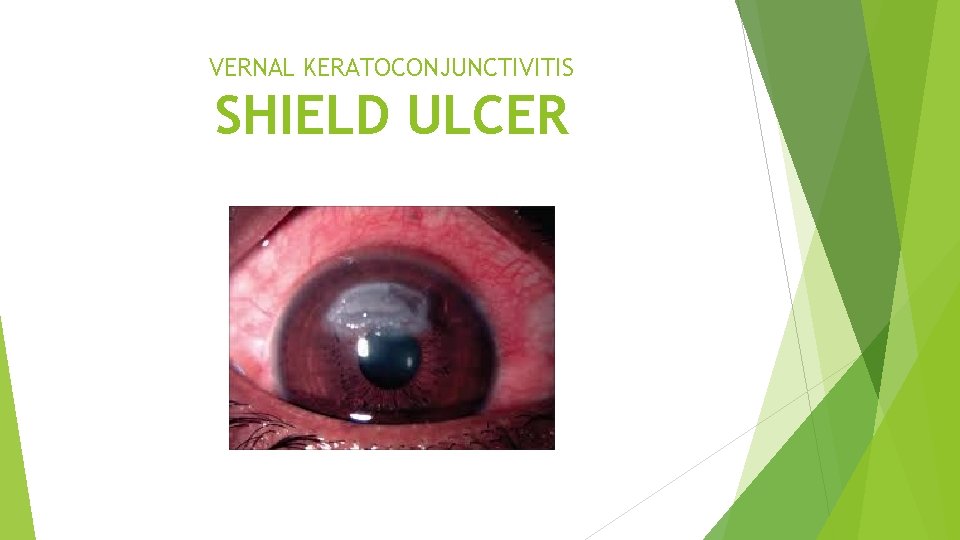 VERNAL KERATOCONJUNCTIVITIS SHIELD ULCER 