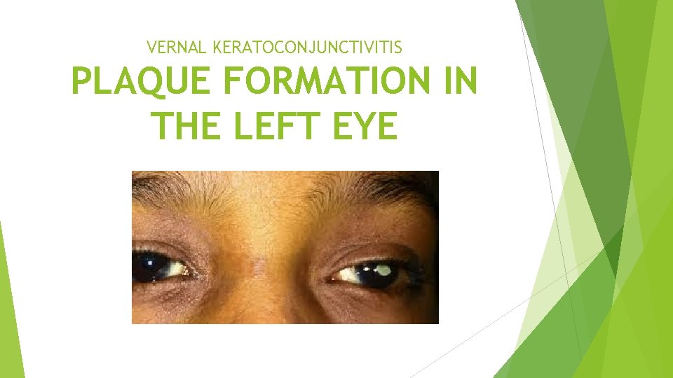 VERNAL KERATOCONJUNCTIVITIS PLAQUE FORMATION IN THE LEFT EYE 