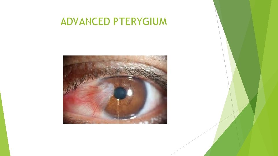 ADVANCED PTERYGIUM 
