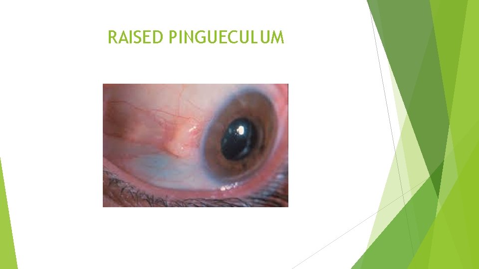 RAISED PINGUECULUM 