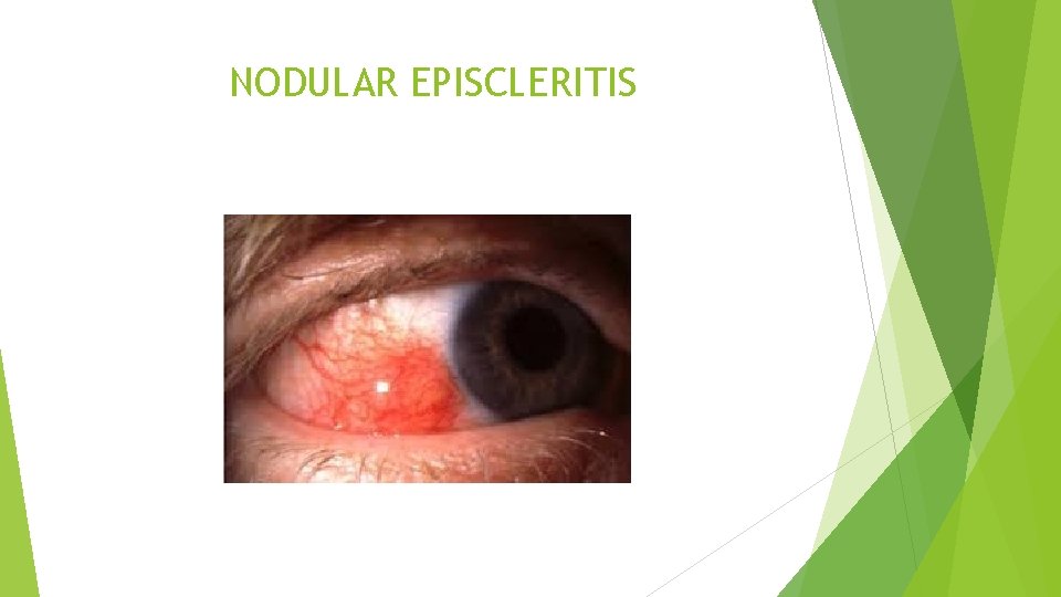 NODULAR EPISCLERITIS 