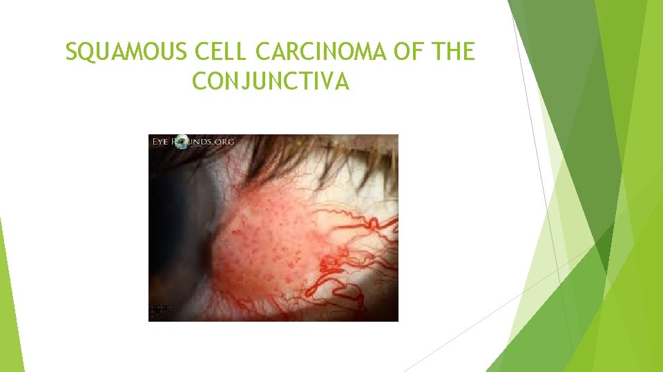 SQUAMOUS CELL CARCINOMA OF THE CONJUNCTIVA 