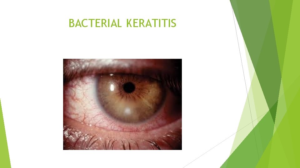 BACTERIAL KERATITIS 