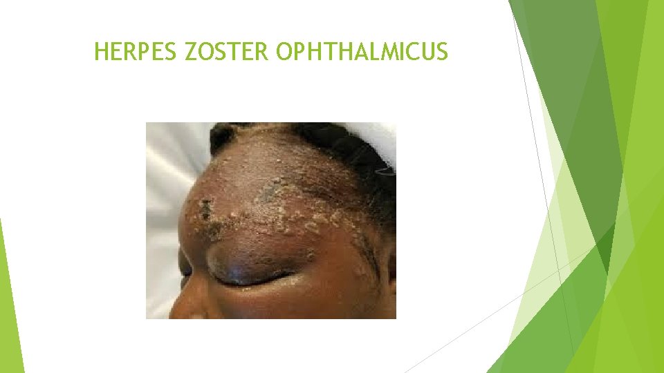 HERPES ZOSTER OPHTHALMICUS 