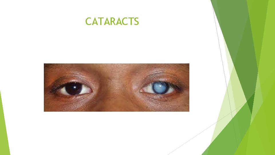 CATARACTS 