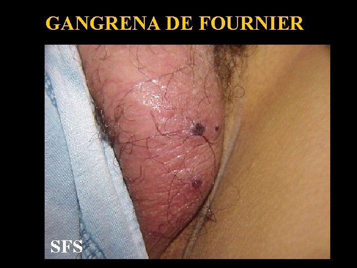 GANGRENA DE FOURNIER 