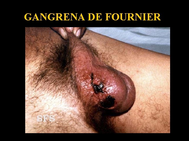 GANGRENA DE FOURNIER 