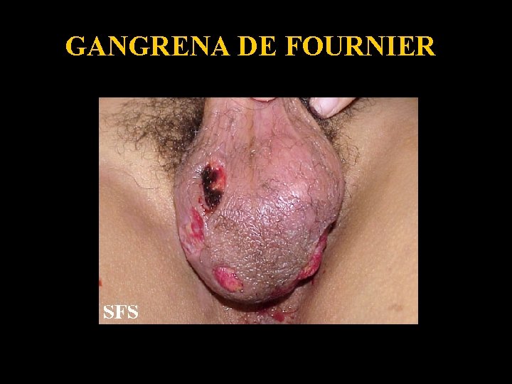 GANGRENA DE FOURNIER 