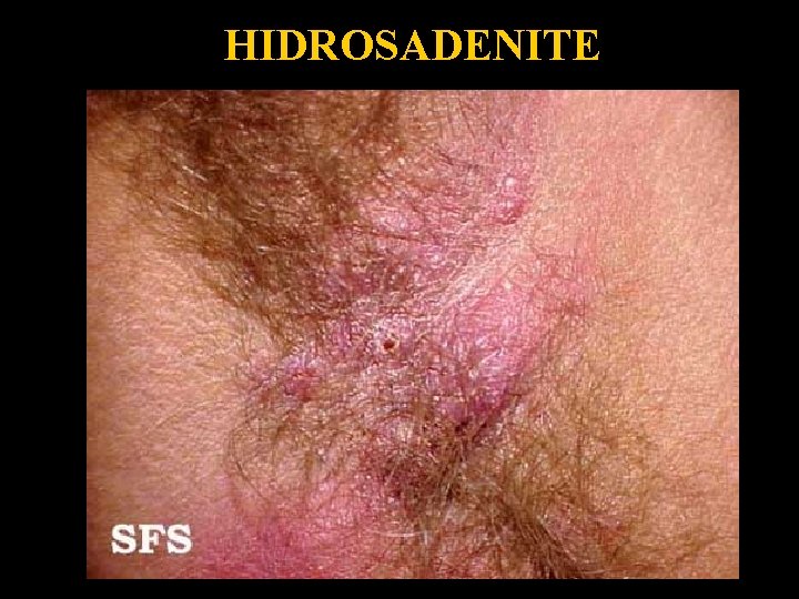 HIDROSADENITE Hidradenitis 2 