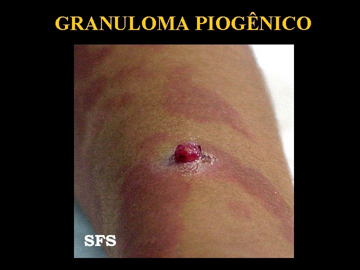 GRANULOMA PIOGÊNICO 