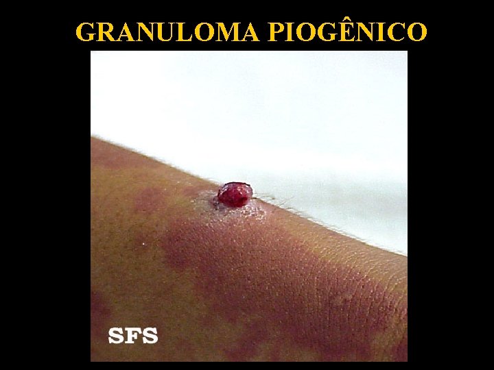 GRANULOMA PIOGÊNICO 