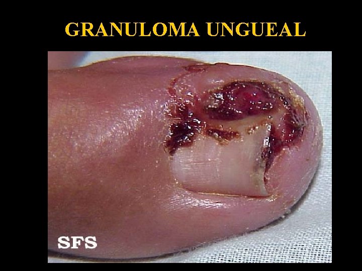 GRANULOMA UNGUEAL 