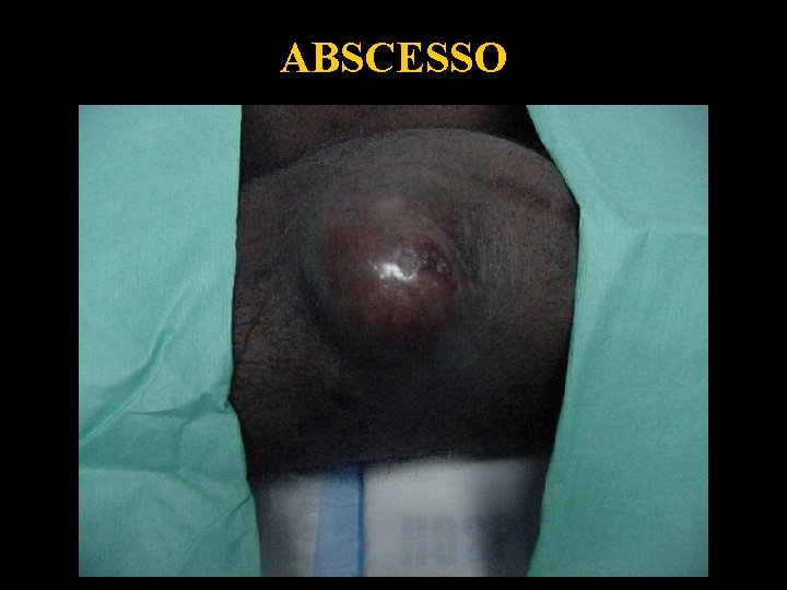 ABSCESSO 