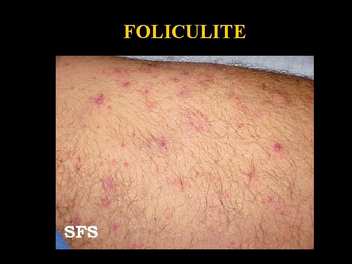 Folliculitis 4 FOLICULITE 