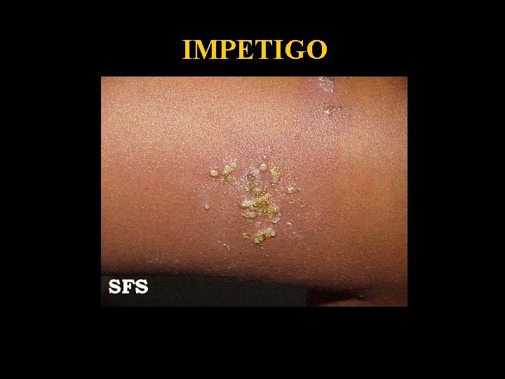 IMPETIGO 