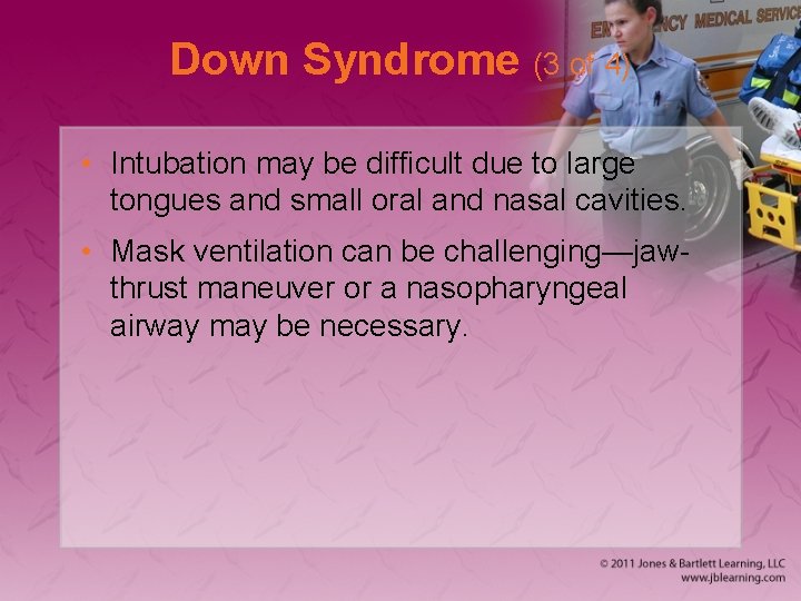 Down Syndrome (3 of 4) • Intubation may be difficult due to large tongues