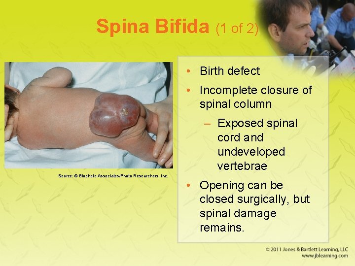 Spina Bifida (1 of 2) • Birth defect • Incomplete closure of spinal column