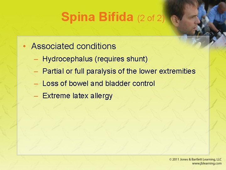 Spina Bifida (2 of 2) • Associated conditions – Hydrocephalus (requires shunt) – Partial