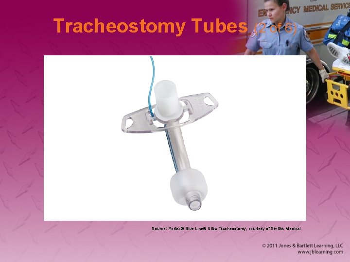 Tracheostomy Tubes (2 of 6) Source: Portex® Blue Line® Ultra Tracheostomy, courtesy of Smiths