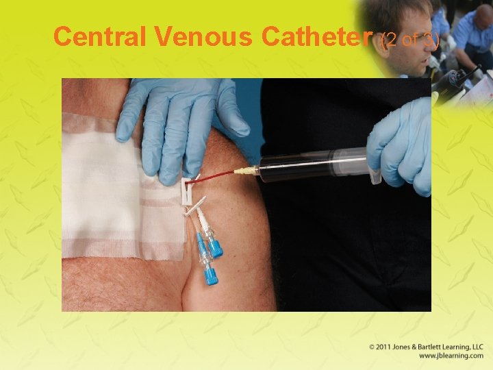 Central Venous Catheter (2 of 3) 