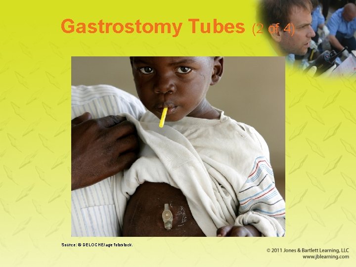 Gastrostomy Tubes (2 of 4) Source: © DELOCHE/age fotostock. 