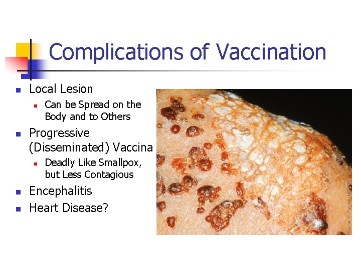 Complications of Vaccination n Local Lesion n n Progressive (Disseminated) Vaccina n n n