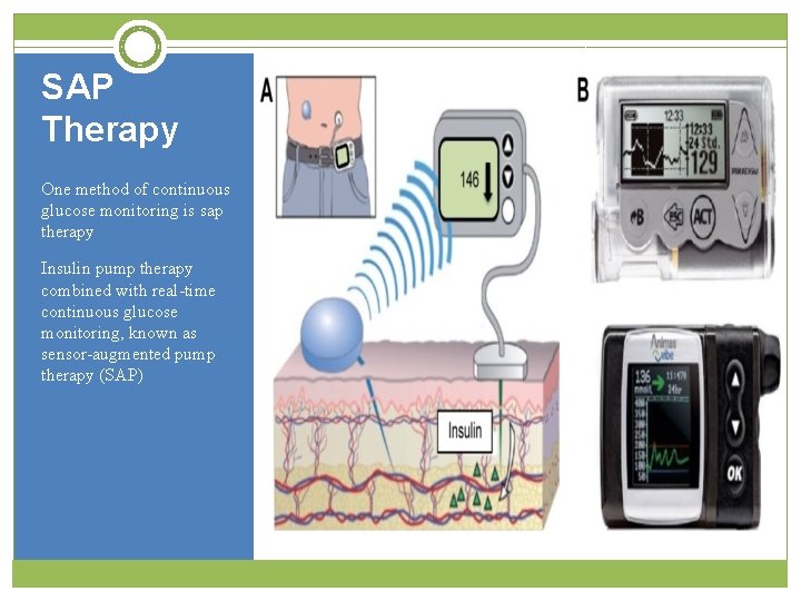 SAP Therapy One method of continuous glucose monitoring is sap therapy Insulin pump therapy