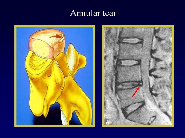 Annular tear 