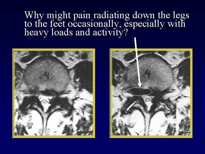 Why might pain radiating down the legs to the feet occasionally, especially with heavy