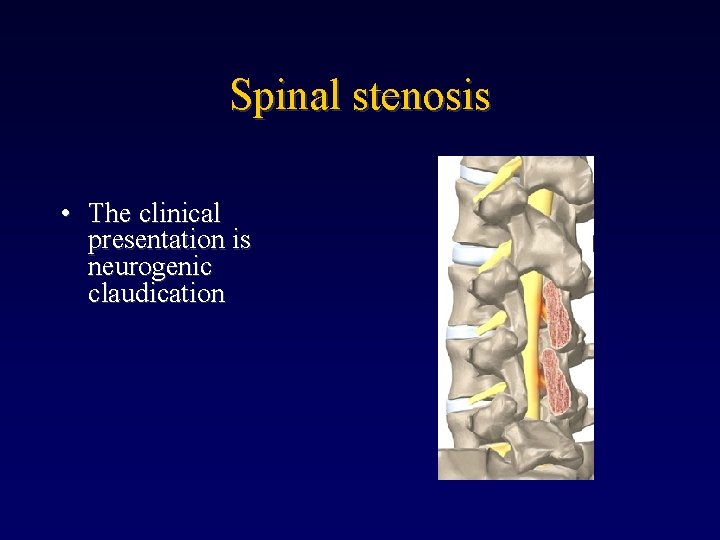 Spinal stenosis • The clinical presentation is neurogenic claudication 