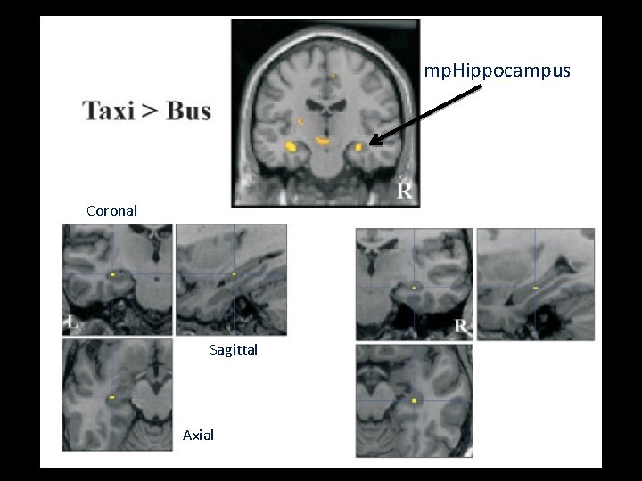 mp. Hippocampus Coronal Sagittal Axial 