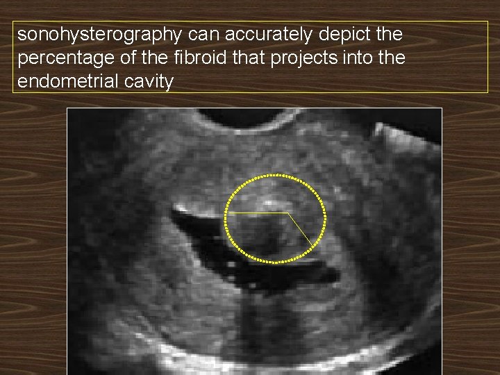 sonohysterography can accurately depict the percentage of the fibroid that projects into the endometrial