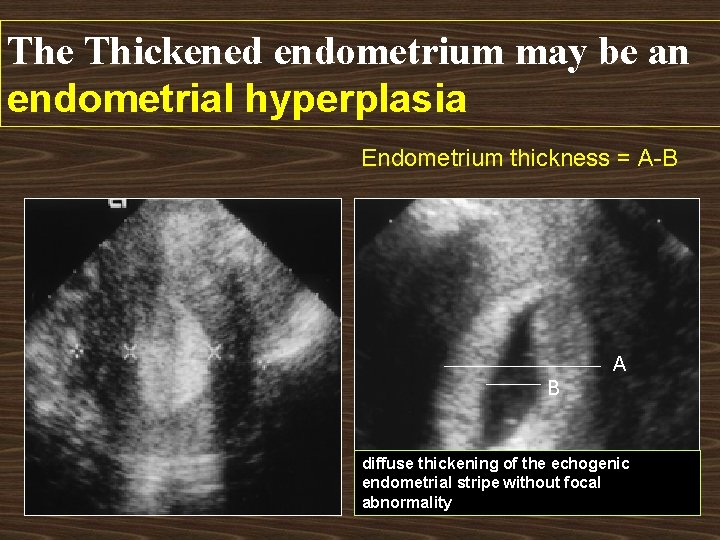The Thickened endometrium may be an endometrial hyperplasia Endometrium thickness = A-B A B