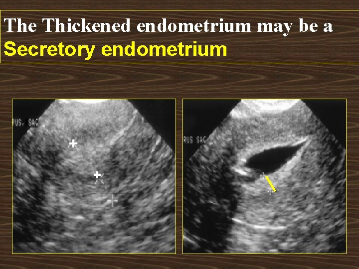 The Thickened endometrium may be a Secretory endometrium + + 