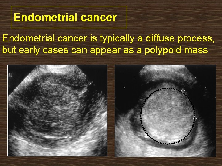 Endometrial cancer is typically a diffuse process, but early cases can appear as a