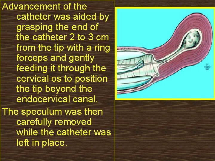 Advancement of the catheter was aided by grasping the end of the catheter 2