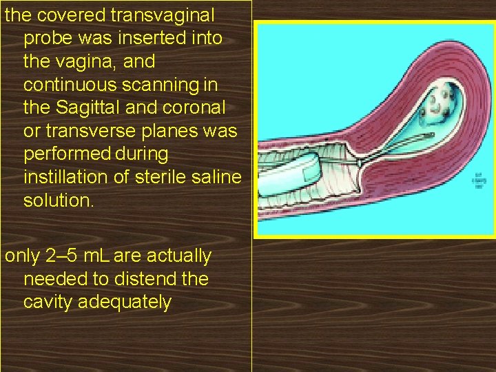 the covered transvaginal probe was inserted into the vagina, and continuous scanning in the