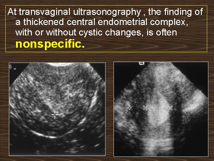 At transvaginal ultrasonography , the finding of a thickened central endometrial complex, with or
