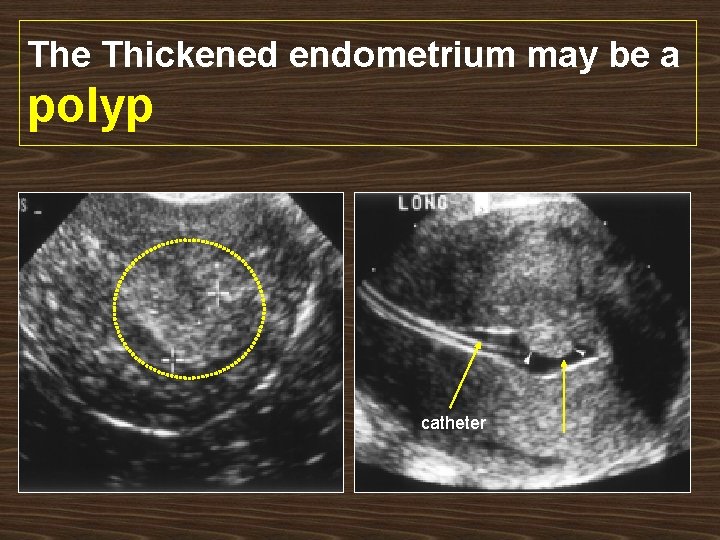 The Thickened endometrium may be a polyp catheter 